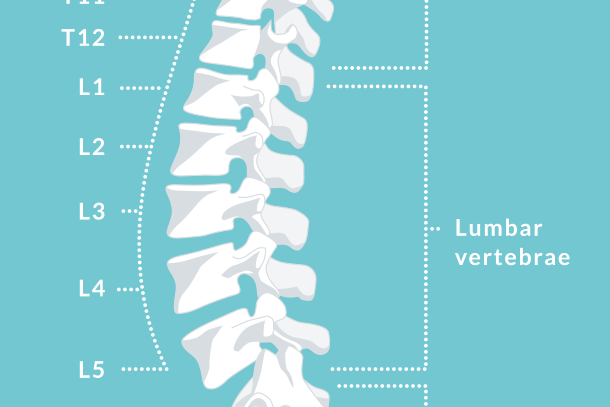 La estenosis espinal lumbar